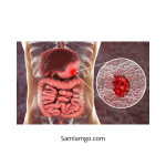Dimana Letak Sakit Tukak Lambung dan Cara Mengenalinya