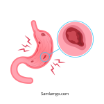 Jenis-Jenis Tukak Lambung: Penyebab, Gejala, dan Penanganannya